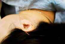 Acupuncturist Suspended for Leaving Needles in Patient’s Head and Toe acupuncturist-suspended-for-leaving-needles-in-patients-head-and-toe