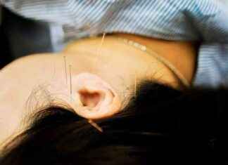 Acupuncturist Suspended for Leaving Needles in Patient’s Head and Toe acupuncturist-suspended-for-leaving-needles-in-patients-head-and-toe